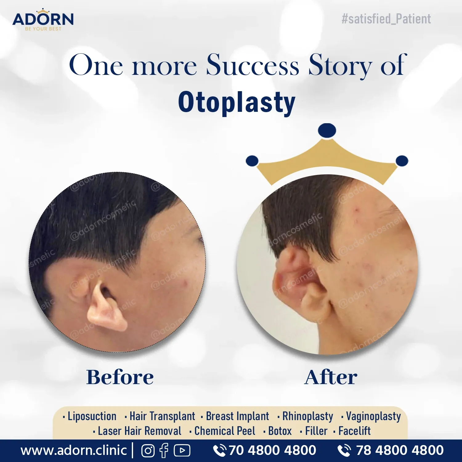 Otoplasty ear reshaping surgery results India before after Ahmedabad