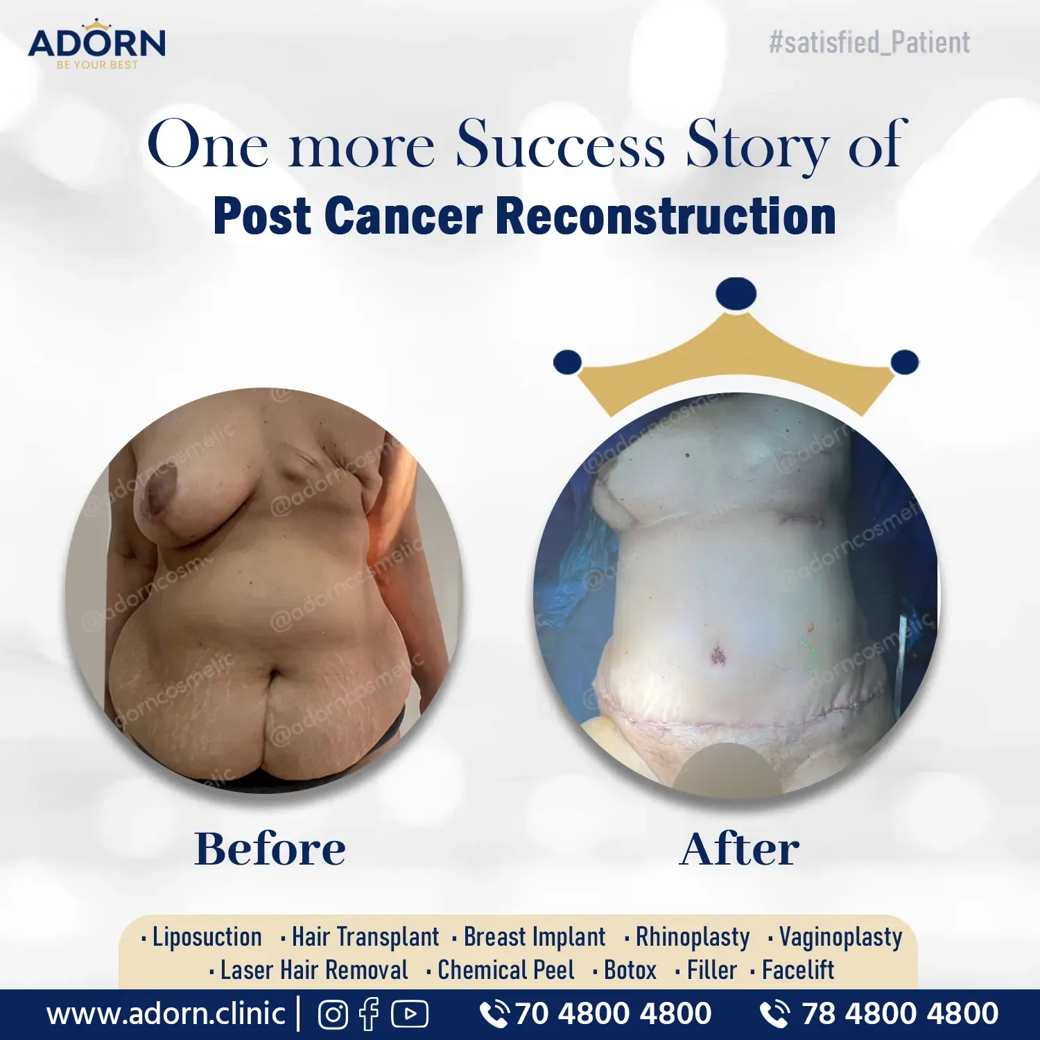 Post breast cancer reconstruction implant Ahmedabad Gujarat before after results India 