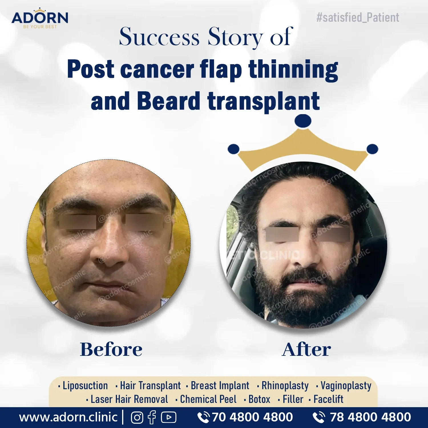 Post cancer face beard hair transplant Ahmedabad 
