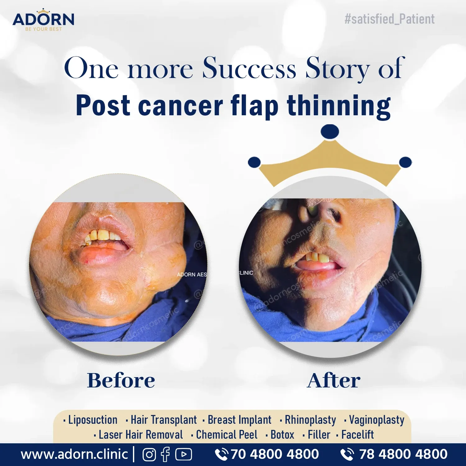 Cancer reconstruction results India before after Ahmedabad