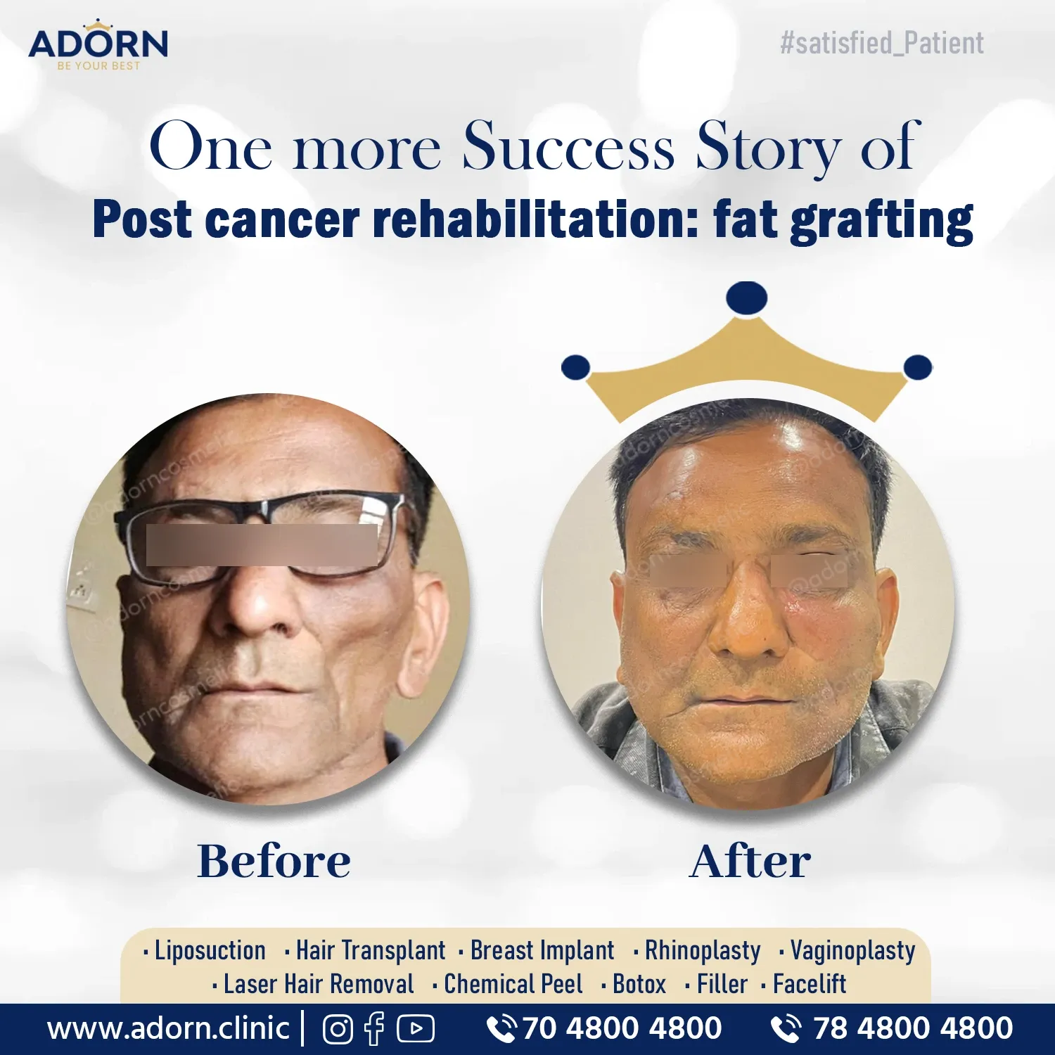Post cancer face fat grafting before after results Ahmedabad 