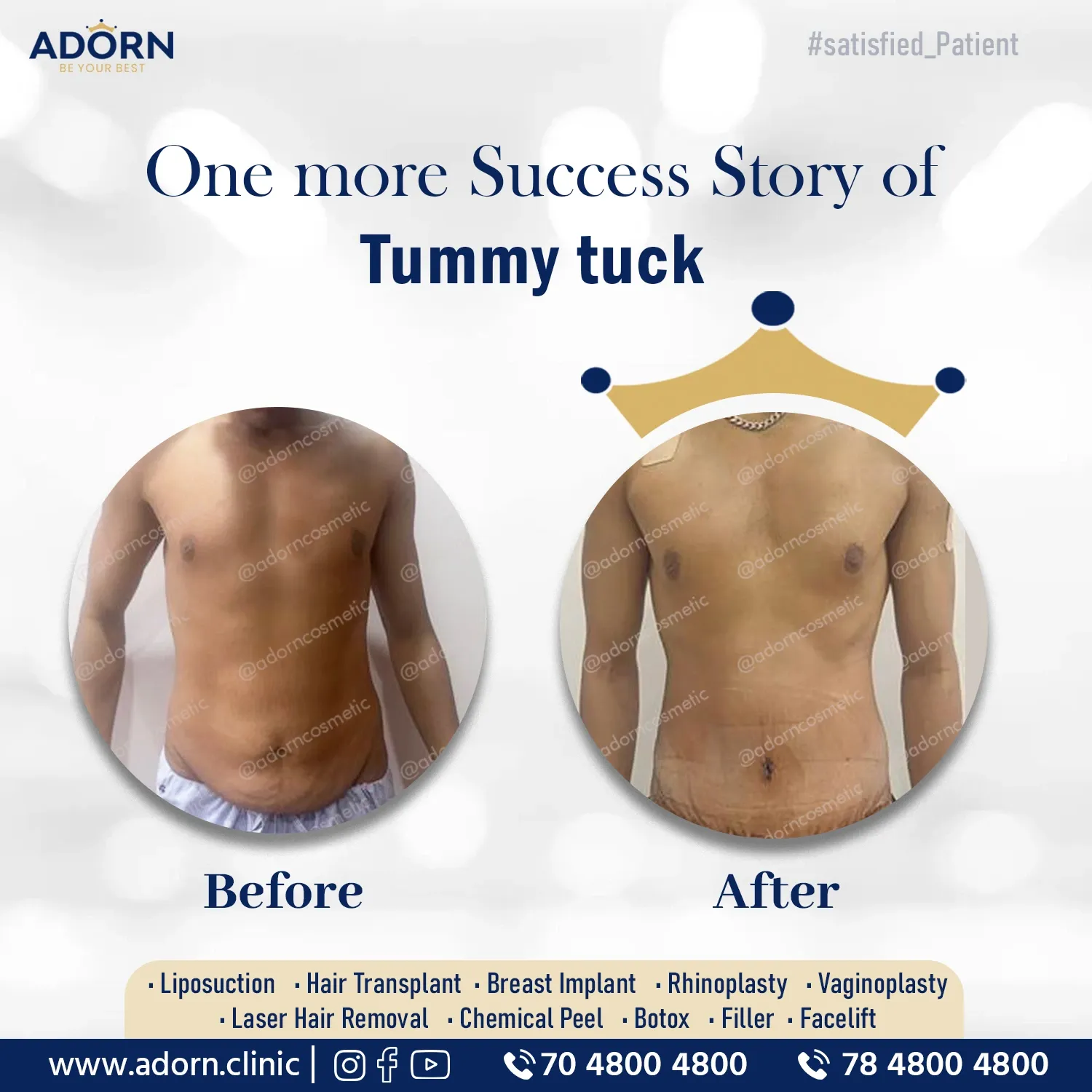 Post weight-loss Tummy_tuck adorn aesthetics before-after result Ahmedabad