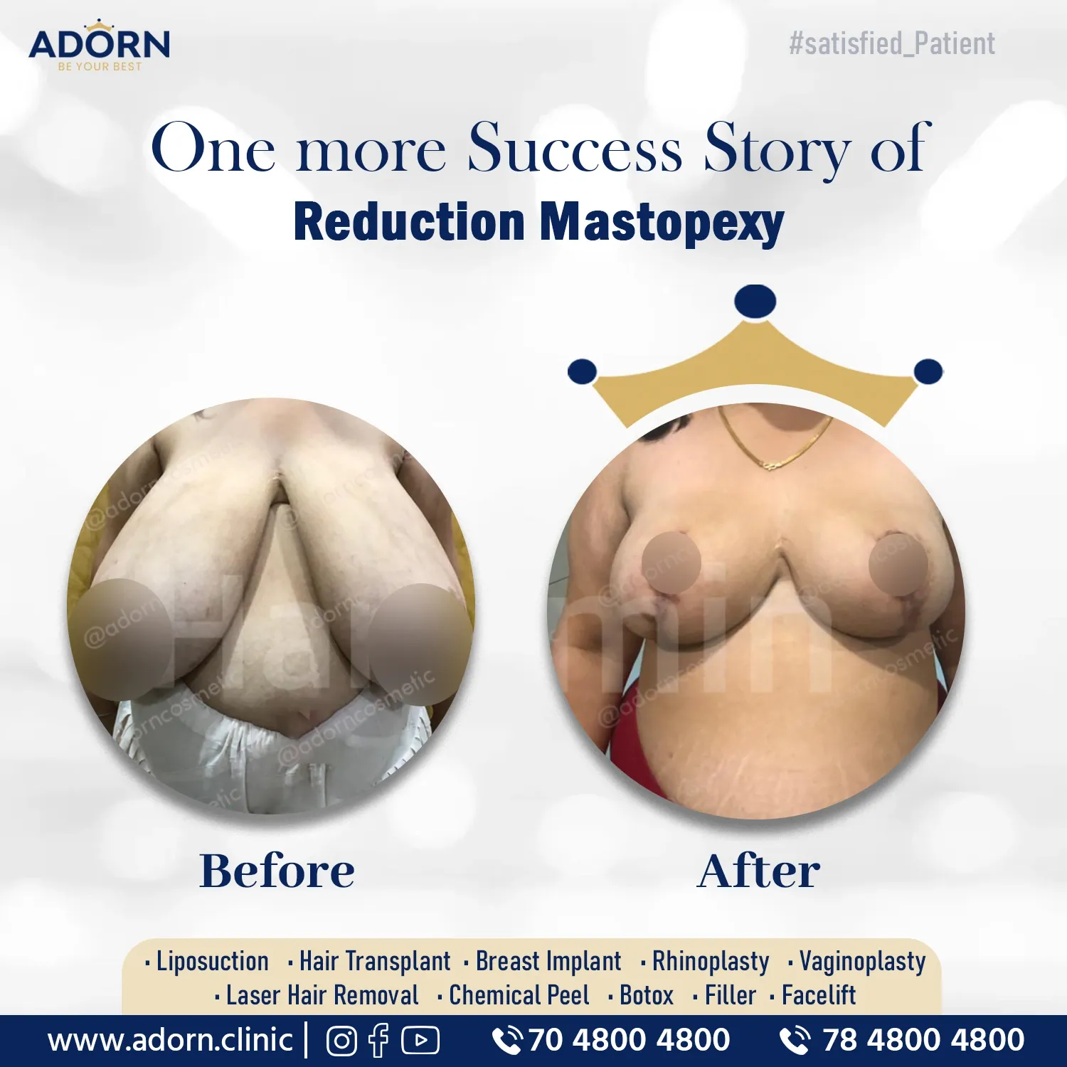 Breast Reduction surgery before after results Ahmedabad Gujarat 