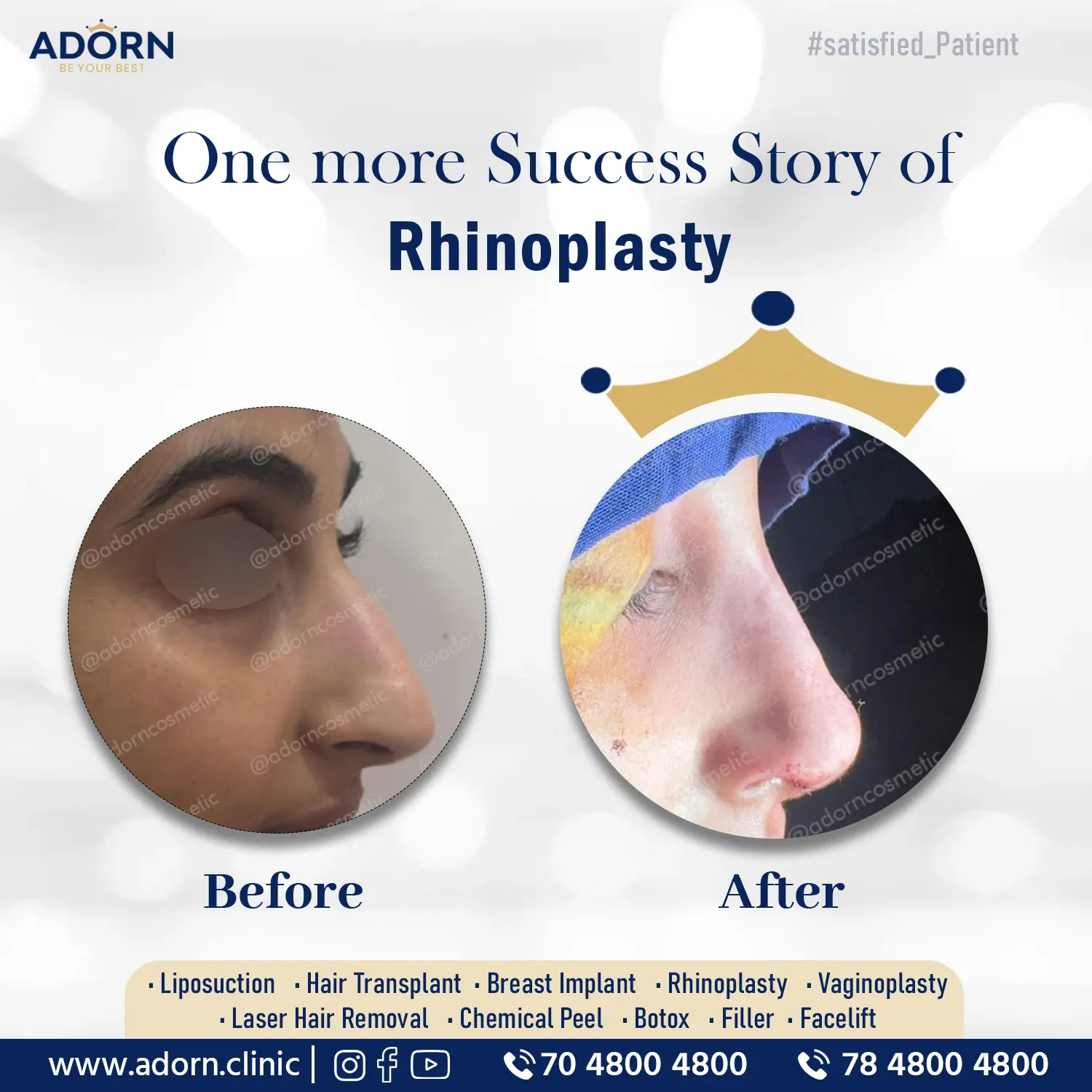 Best nose surgeon in Ahmedabad India before after results cost
