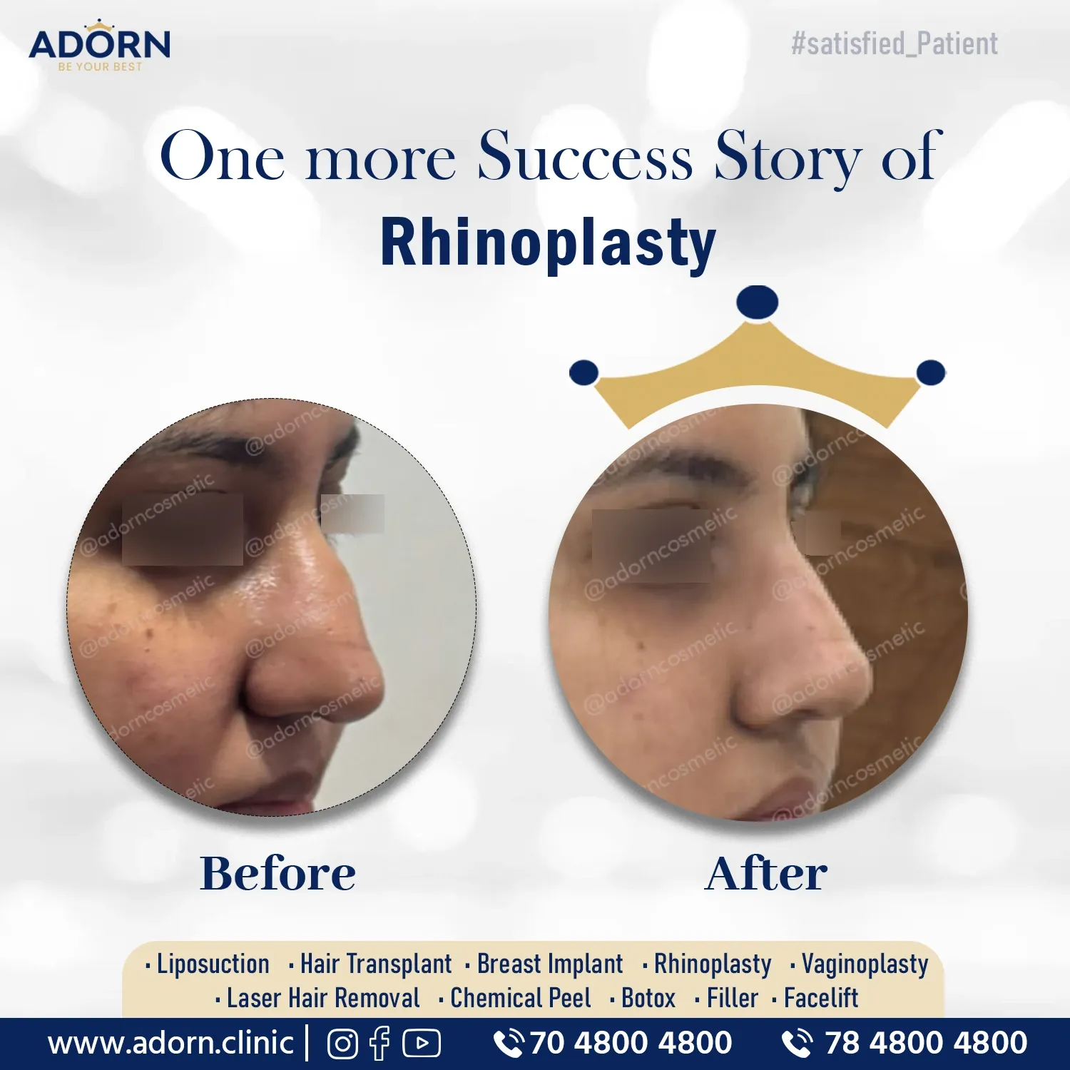 Rhinoplasty nose job surgery results India before after Ahmedabad