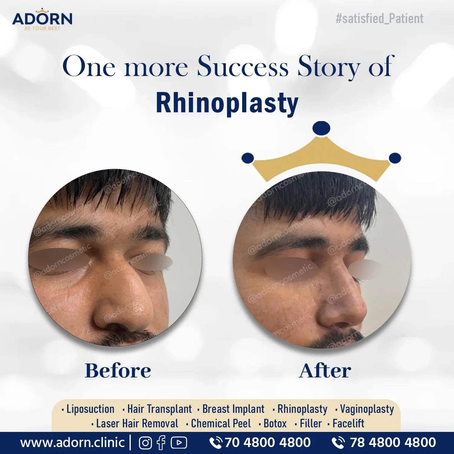 Rhinoplasty nose job surgery results India before after Ahmedabad