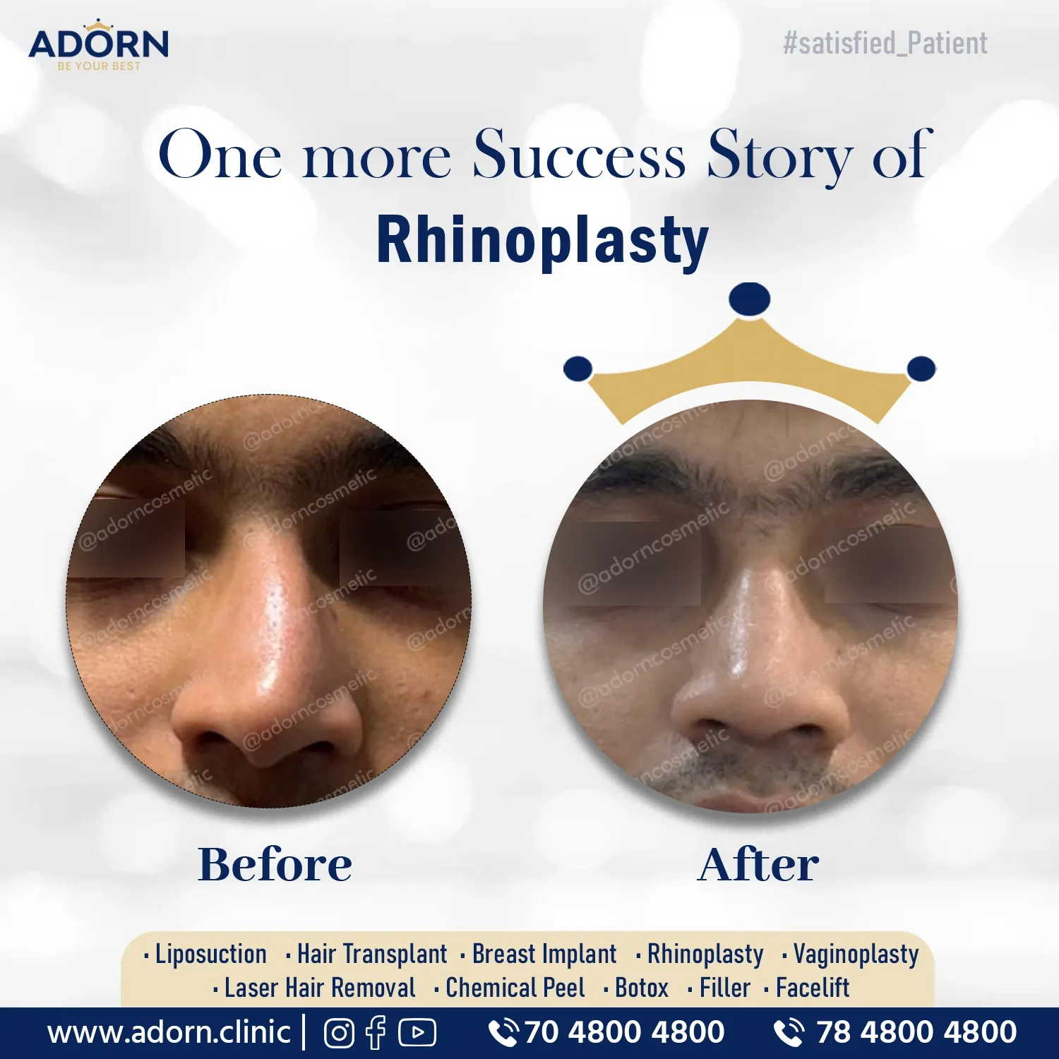 Rhinoplasty nose job surgery results India before after Ahmedabad