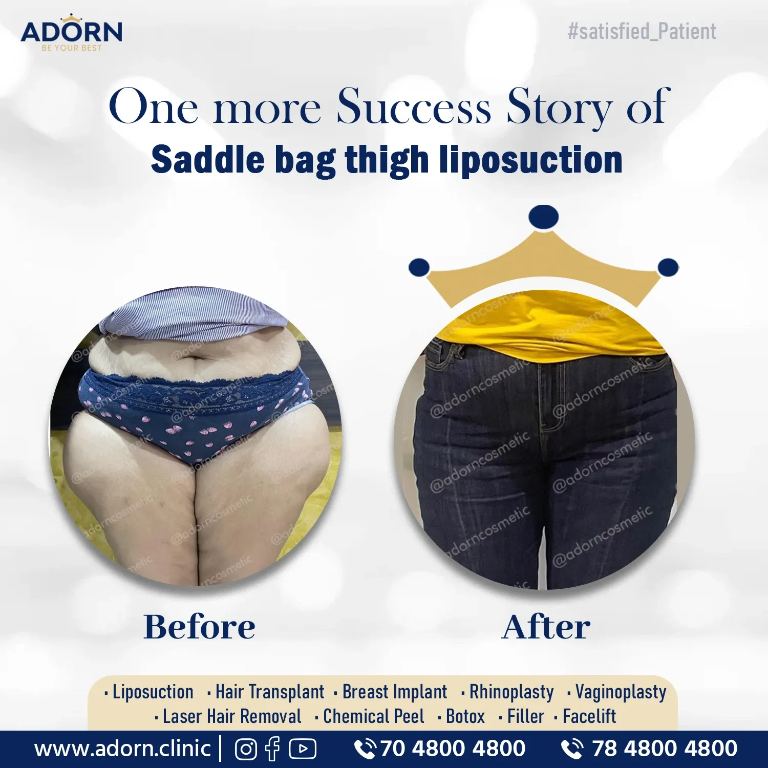Thigh Liposuction in Ahmedabad Gujarat India