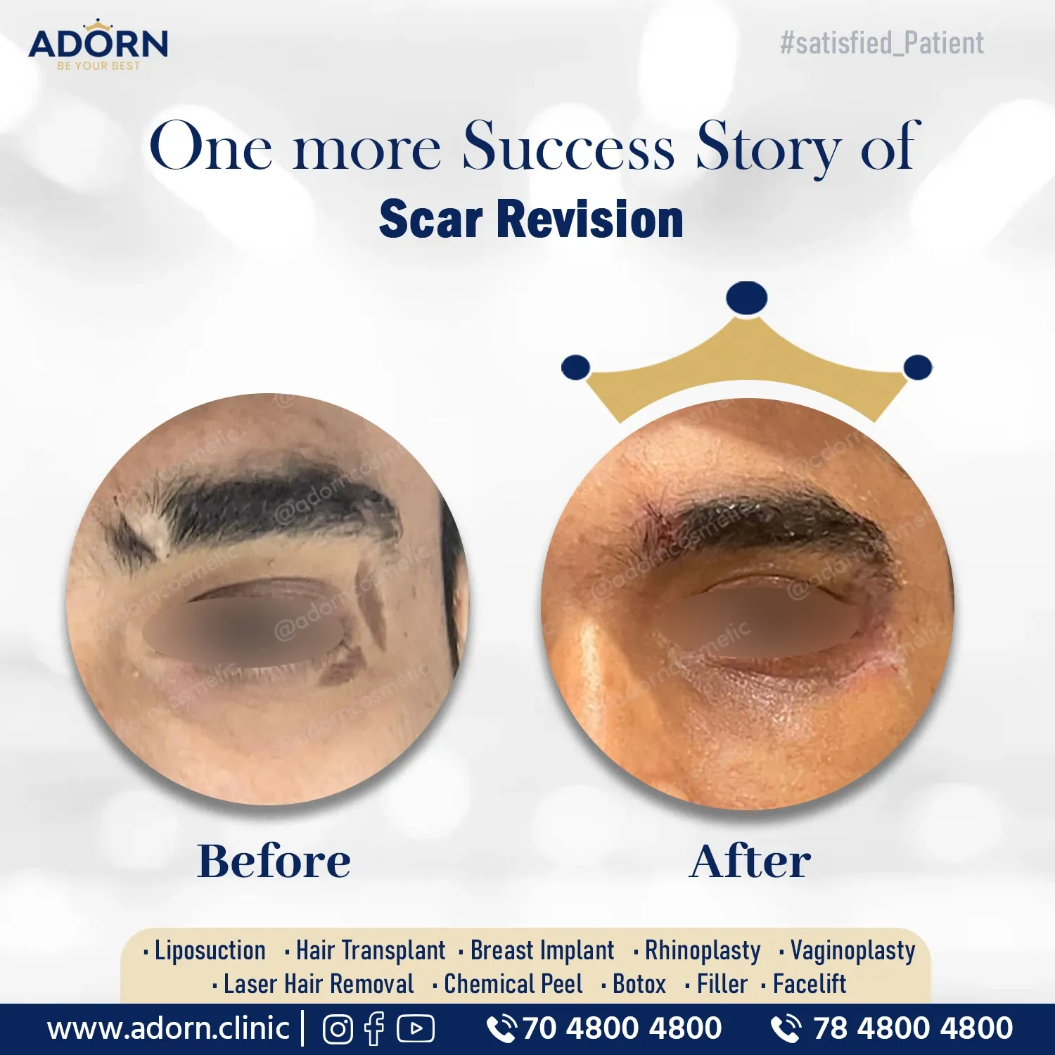 Scar revision surgery before after results in Ahmedabad
