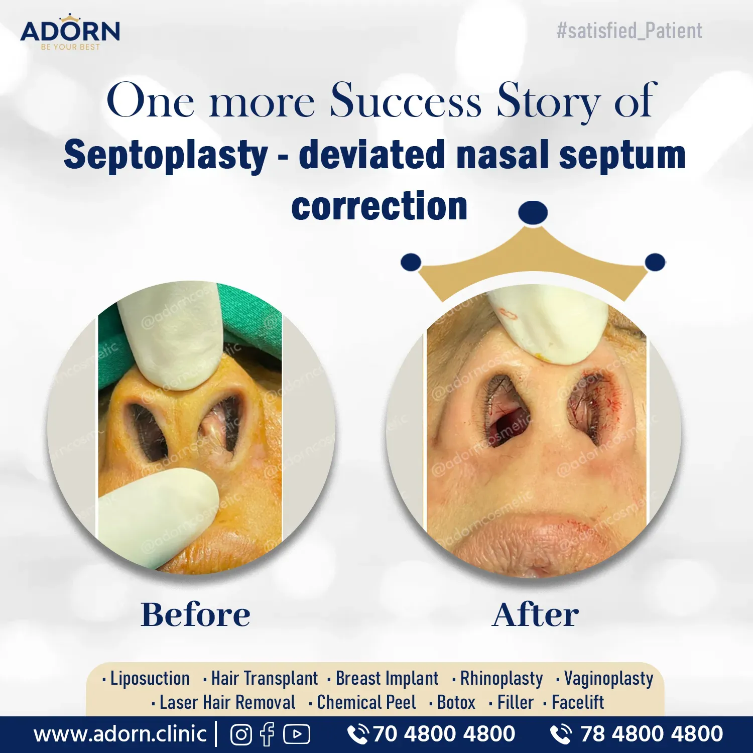 Septoplasty India Ahmedabad rhinoplasty