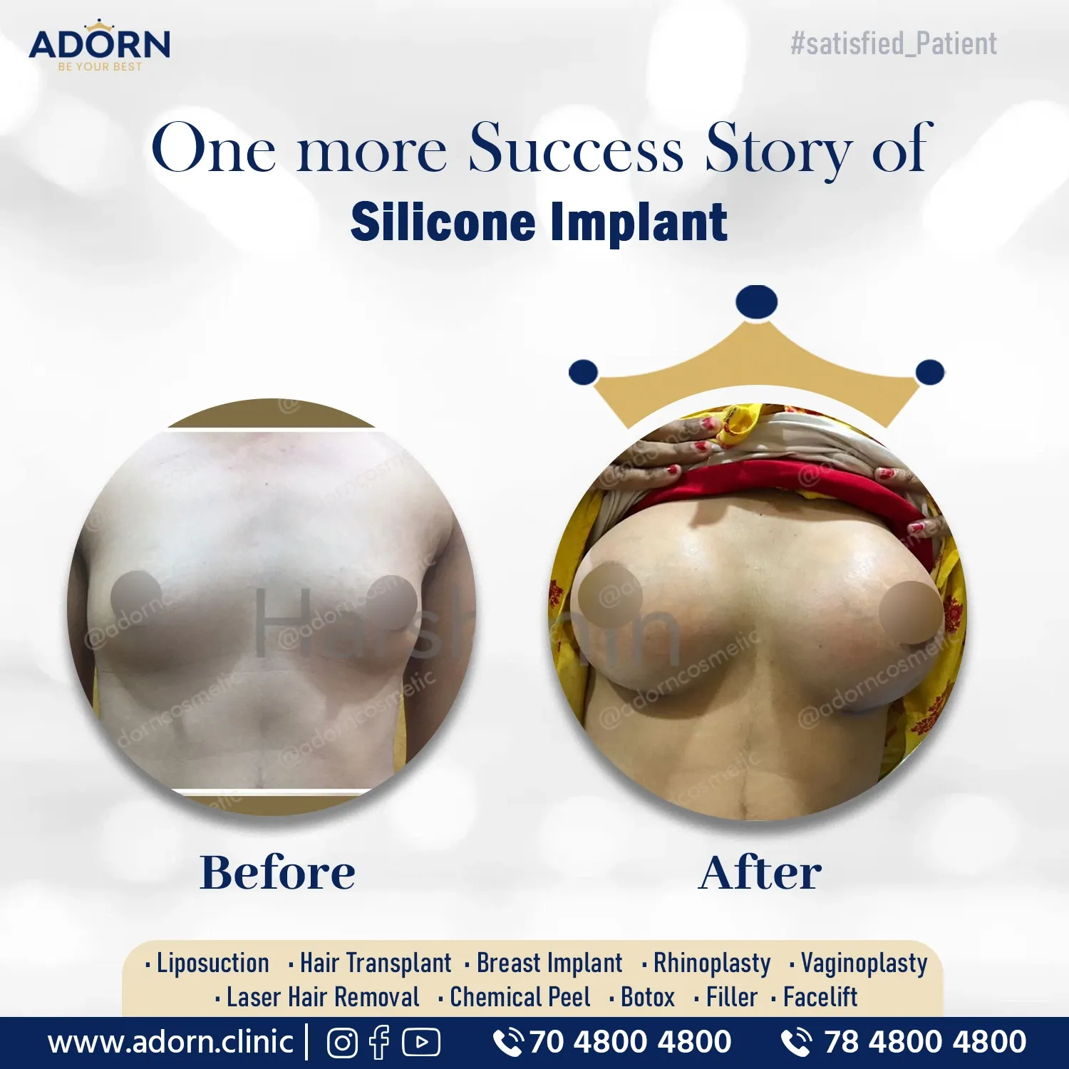 Breast Implant surgery before after results Ahmedabad Gujarat 