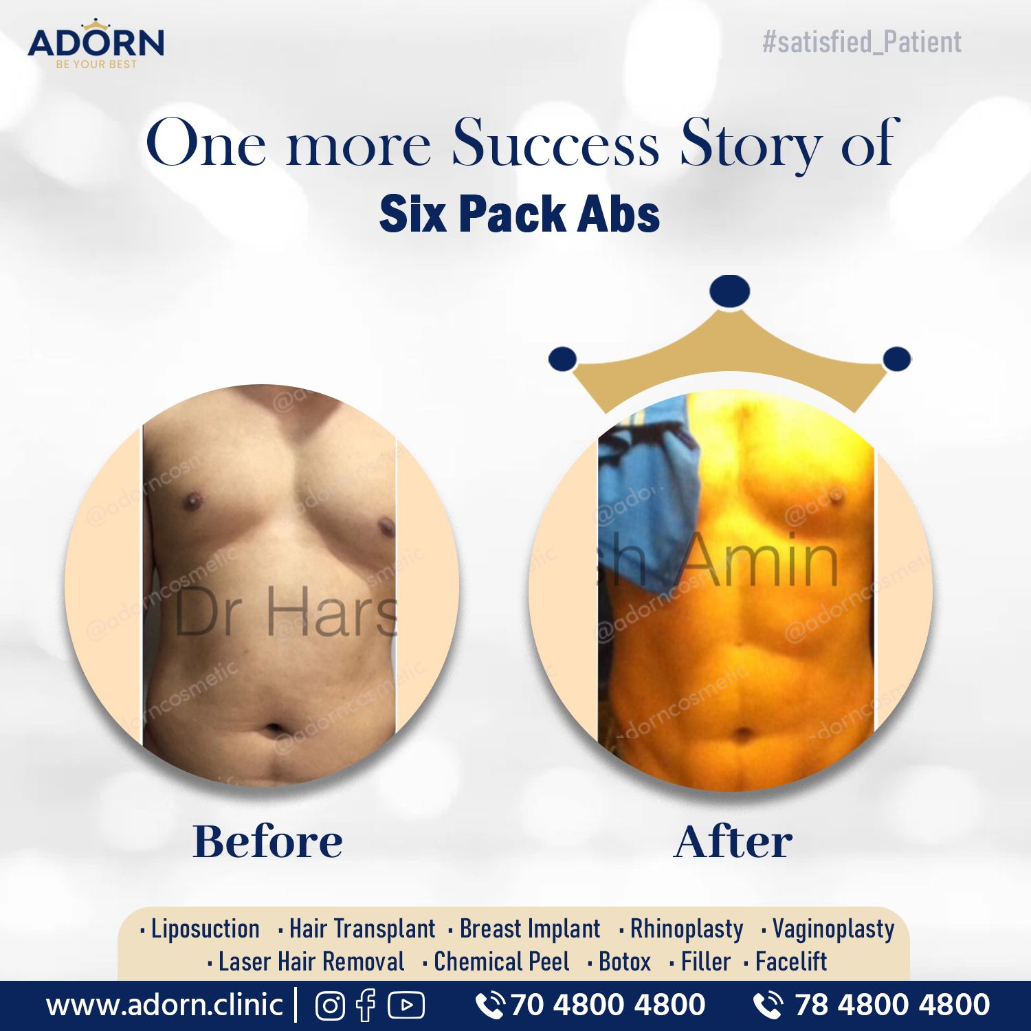Six pack abs before after results Ahmedabad India 