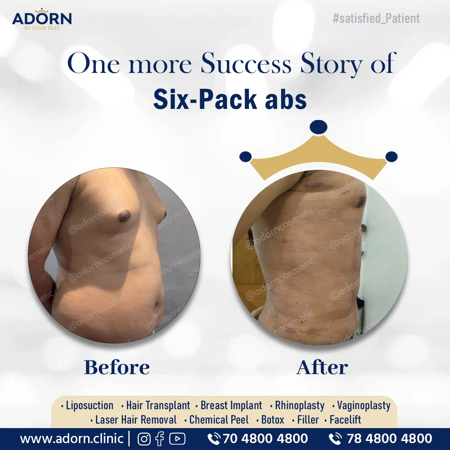 Six pack abs Vaser liposuction in India results 