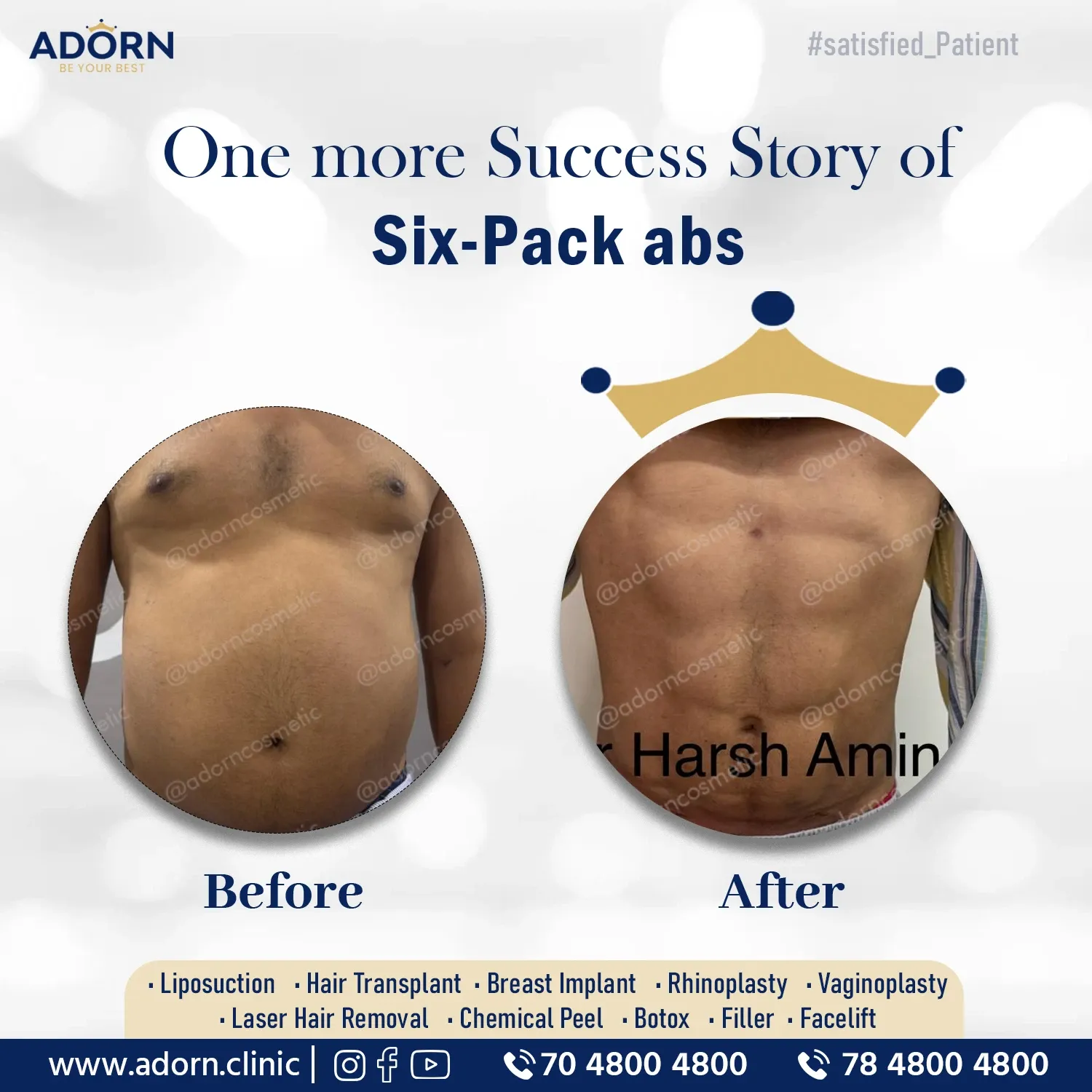 Vaser liposuction results India before after Ahmedabad