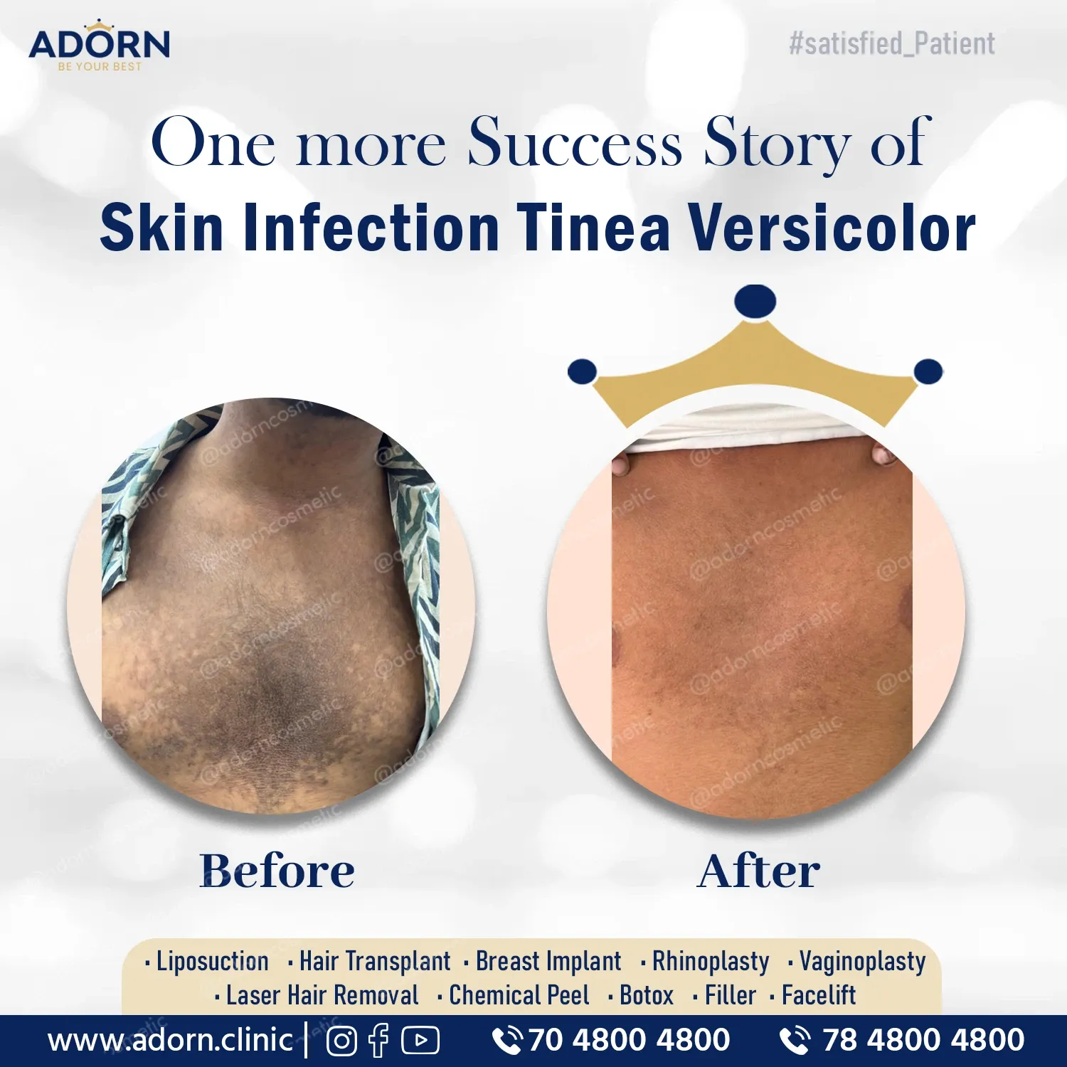 Skin tines fungal infection