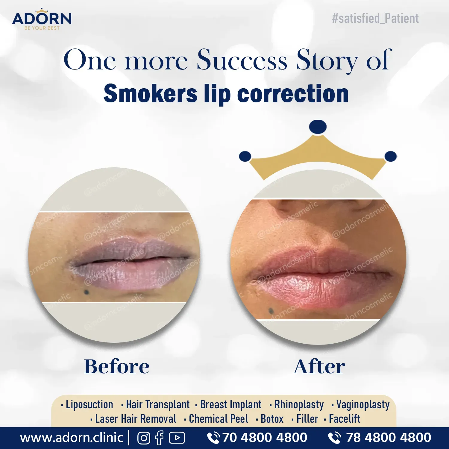 Smoker lip laser treatment 