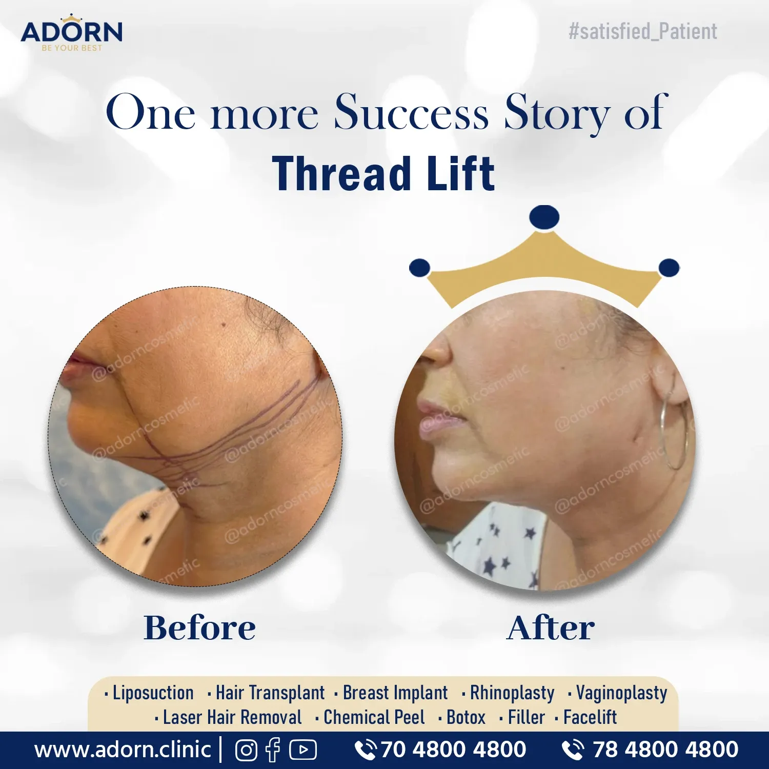 Threadlift results India before after Ahmedabad