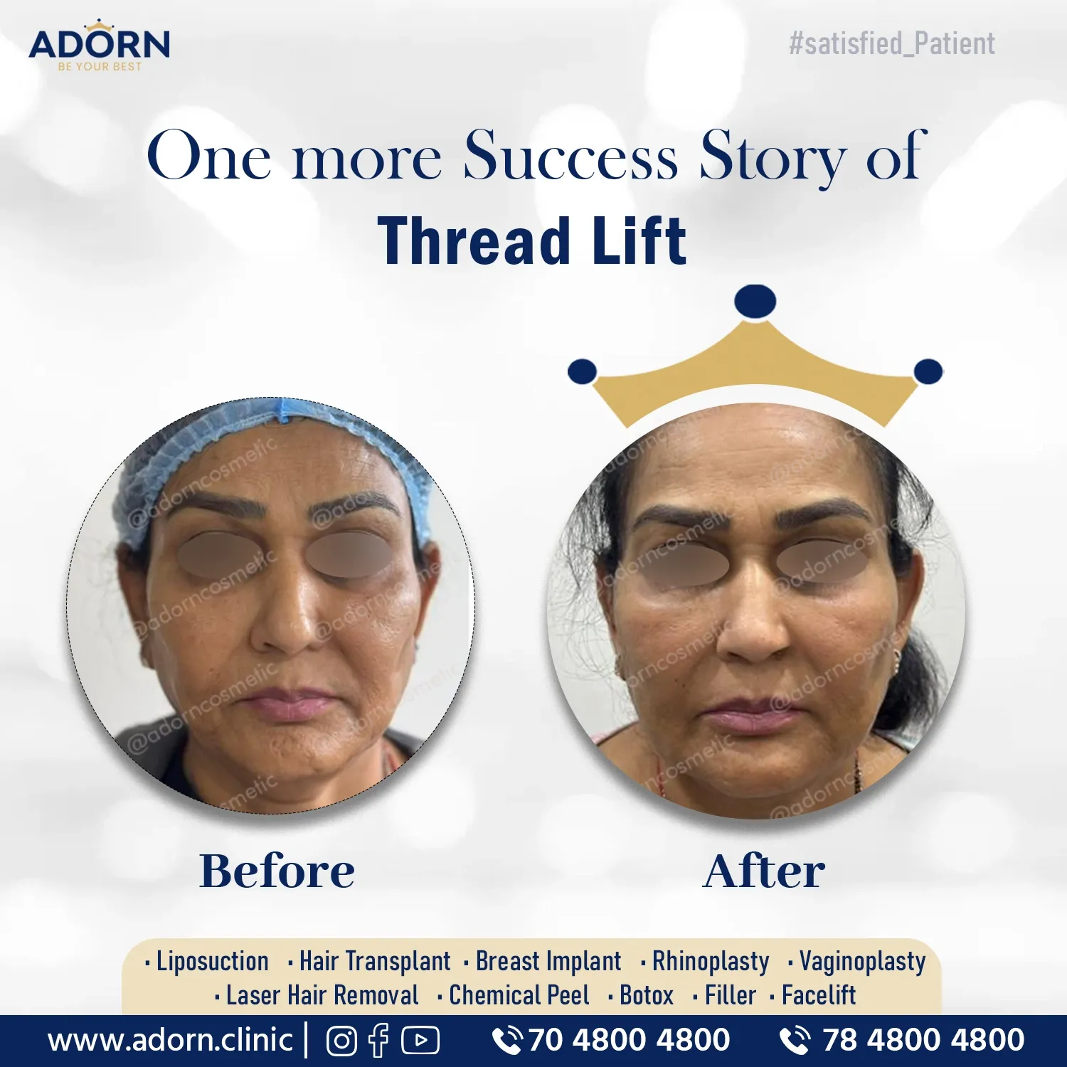 Thread lift results India before after Ahmedabad