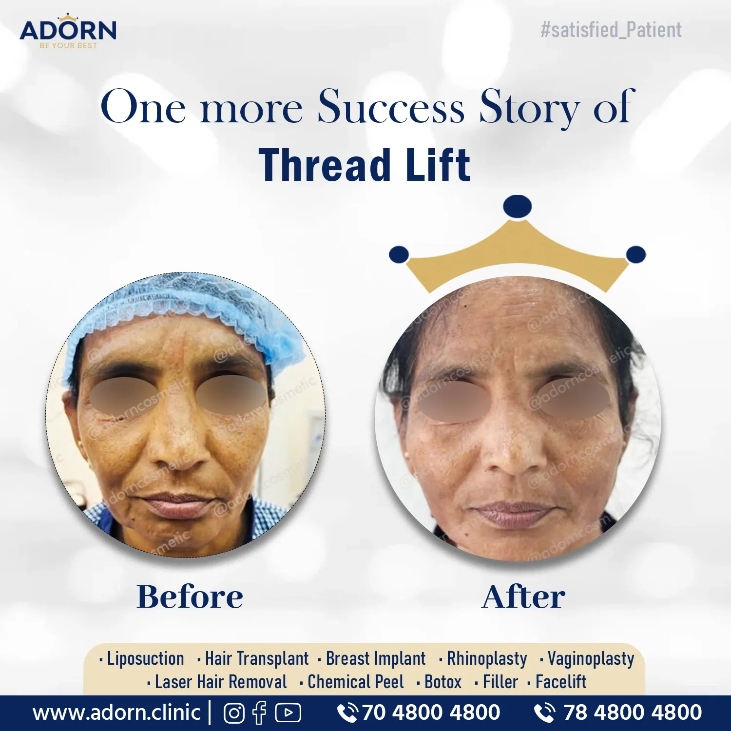 Threadlift results India before after Ahmedabad