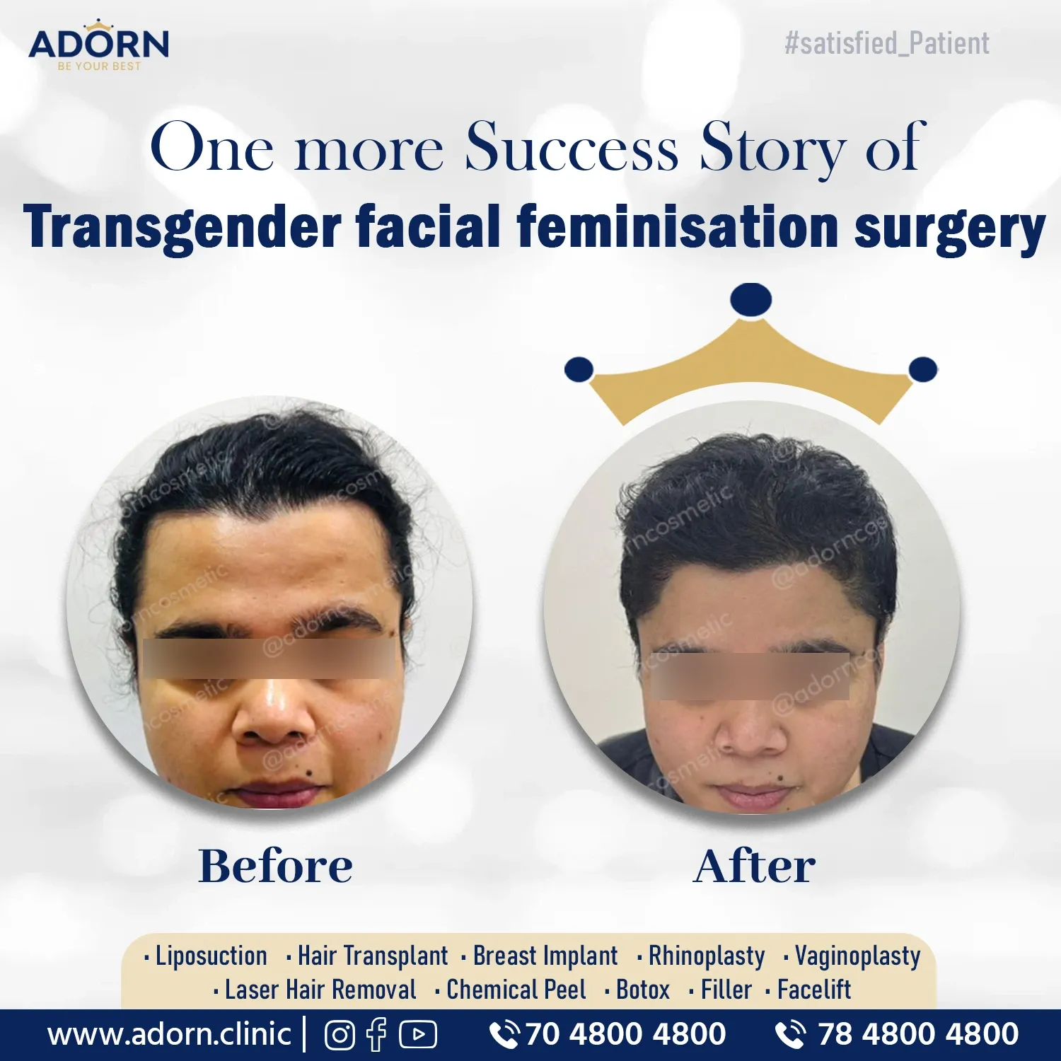 Transgender hair transplant facial feminisation 