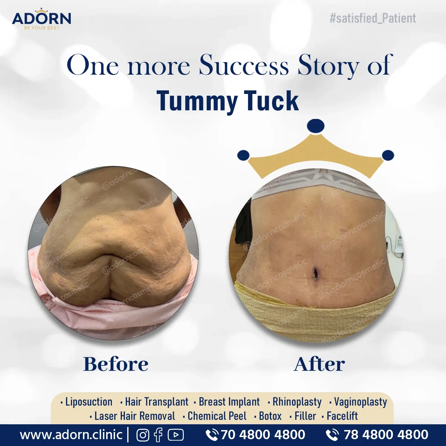 TummyTuck surgery results India before after Ahmedabad