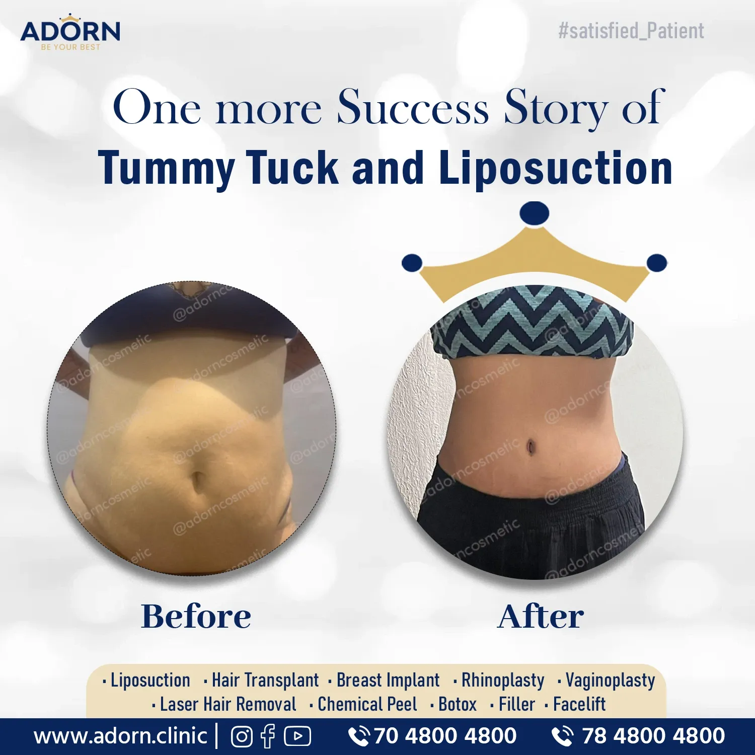 Best Tummy tuck in Ahmedabad India before after results cost