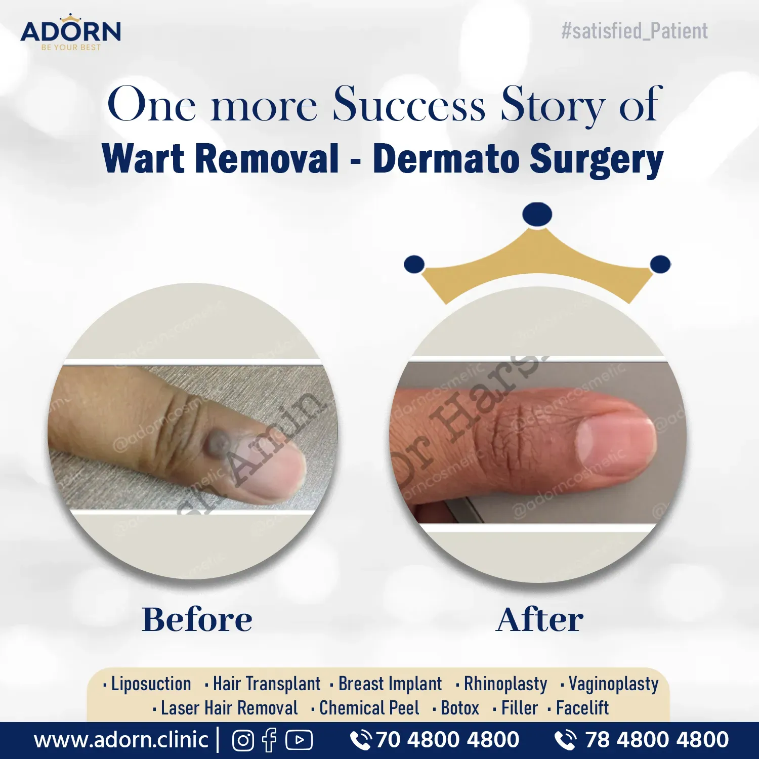 Finger Wart removal co2 laser