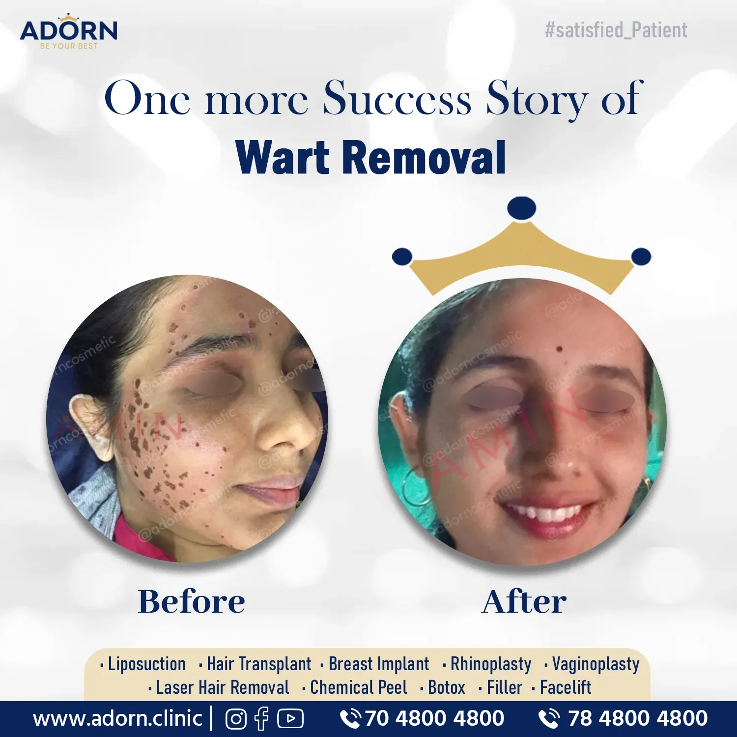 Face wart removal co2 laser