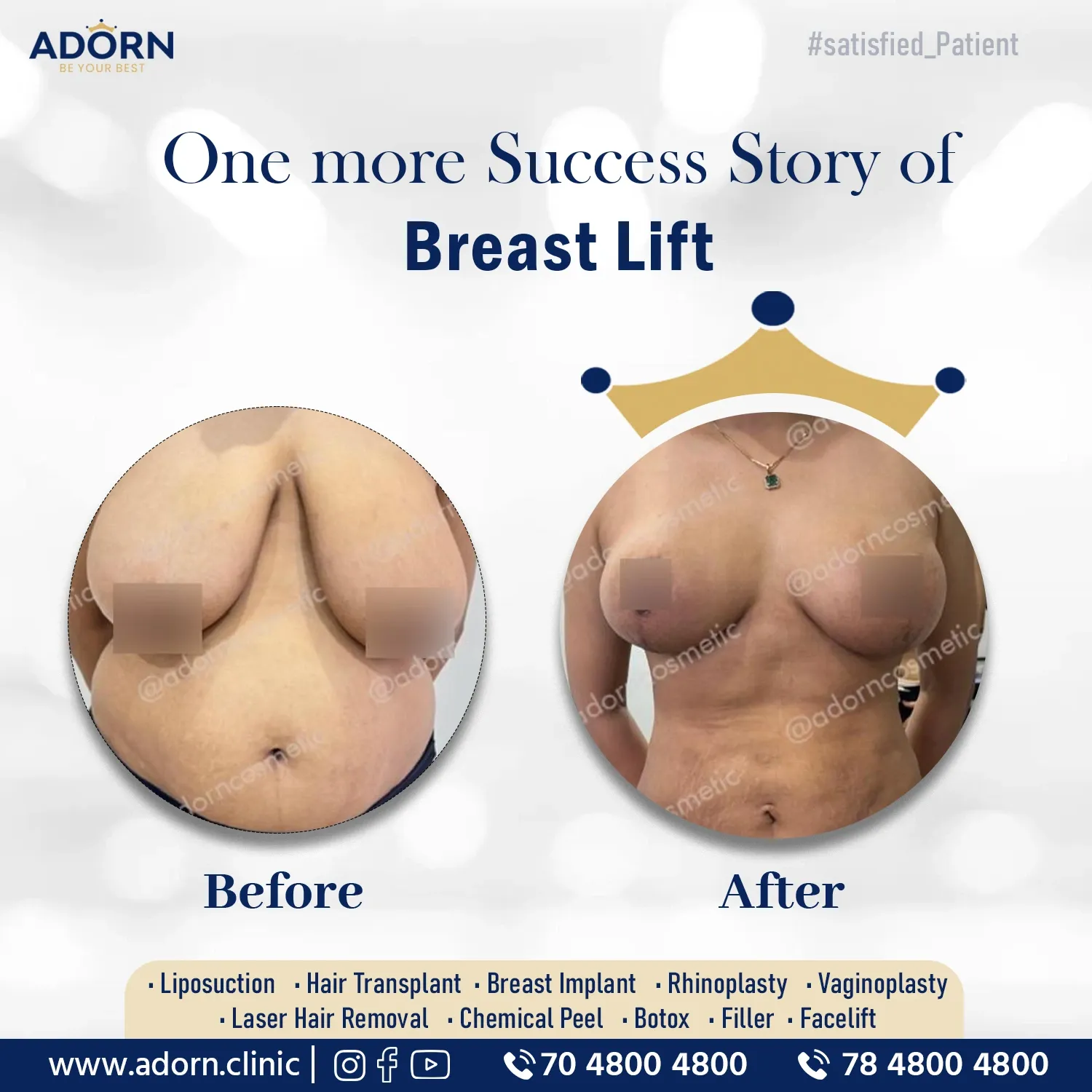 Best Breast lift reduction lift before after results India Ahmedabad 