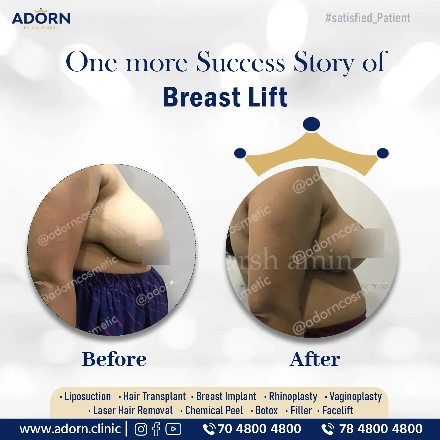 Breast reduction lift before after results India Ahmedabad 