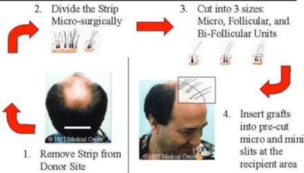 fut-method-of-hair-trnsplant-india