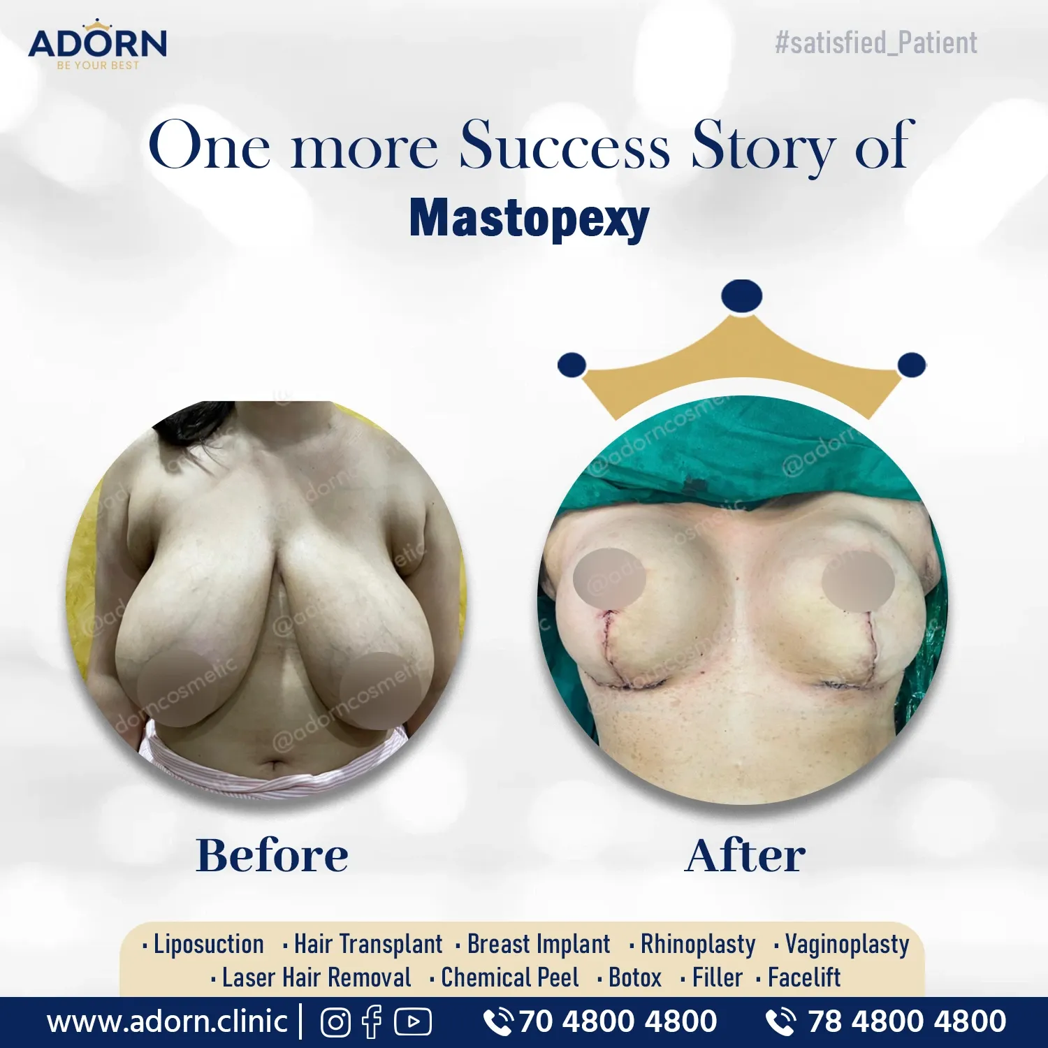Breast lift surgery surgery before after results Ahmedabad Gujarat 