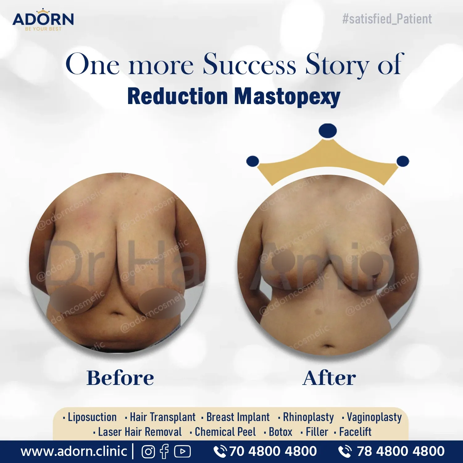 Breast reduction surgery before after results Ahmedabad Gujarat 