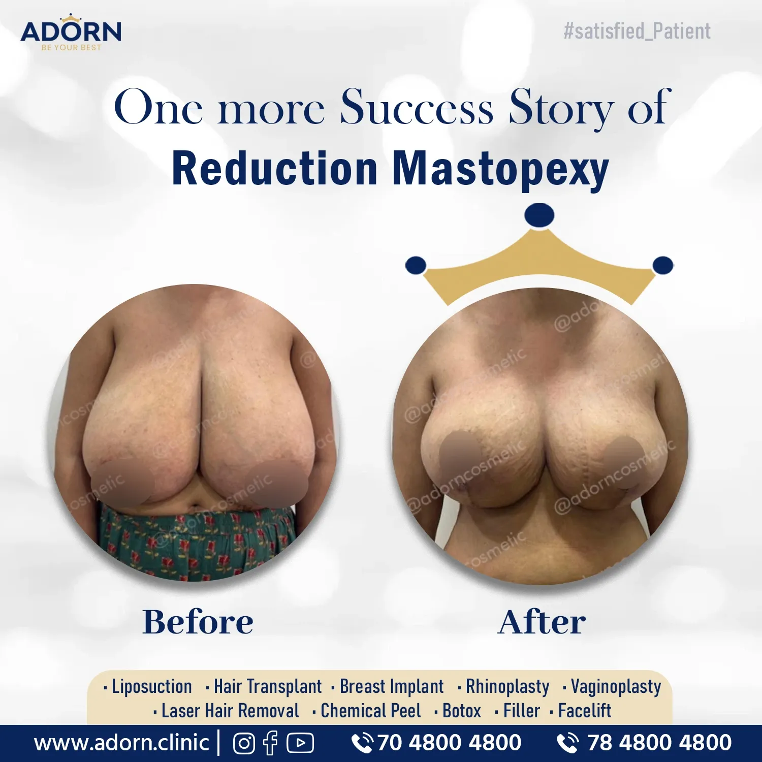 Breast Reduction Before After Results in Ahmedabad