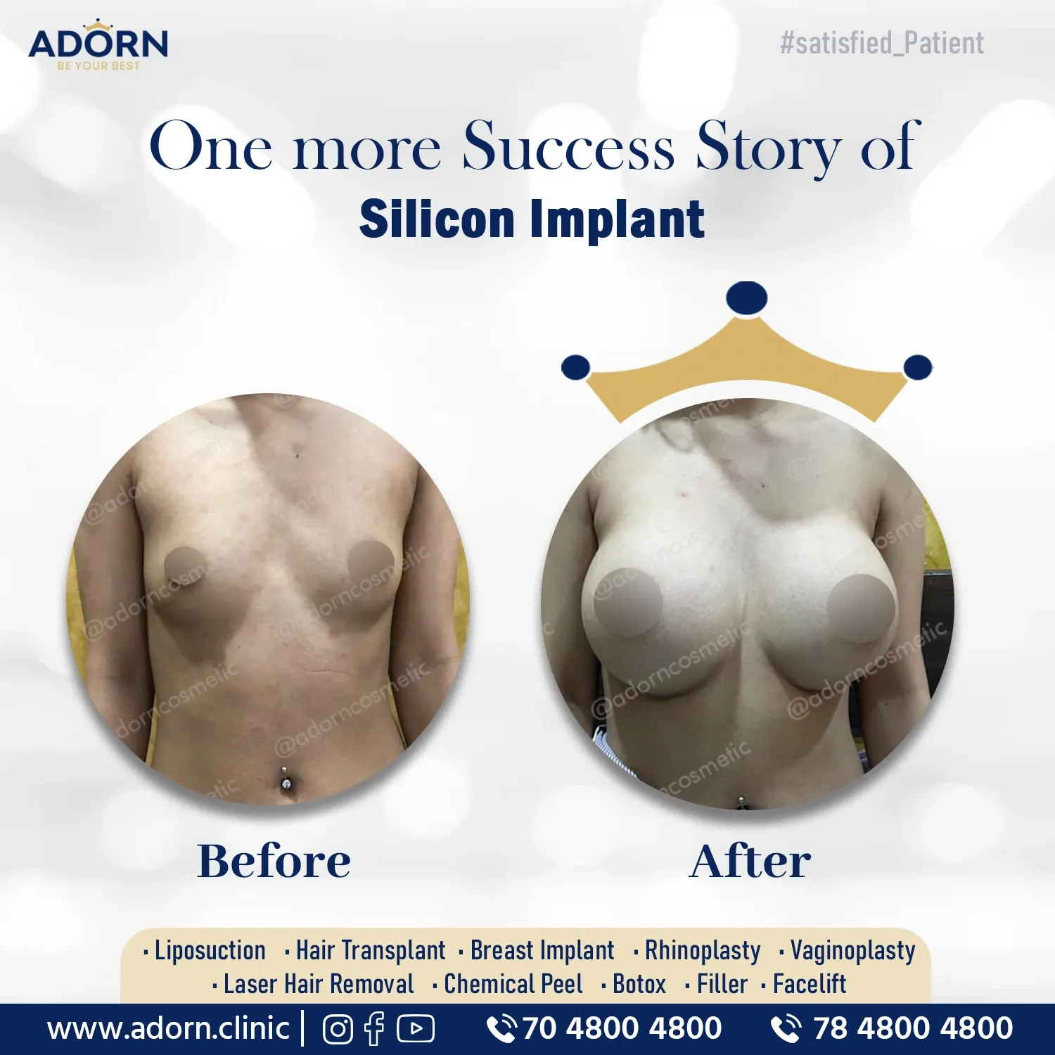Breast Augmentation silicon implant surgery before after results Ahmedabad Gujarat 