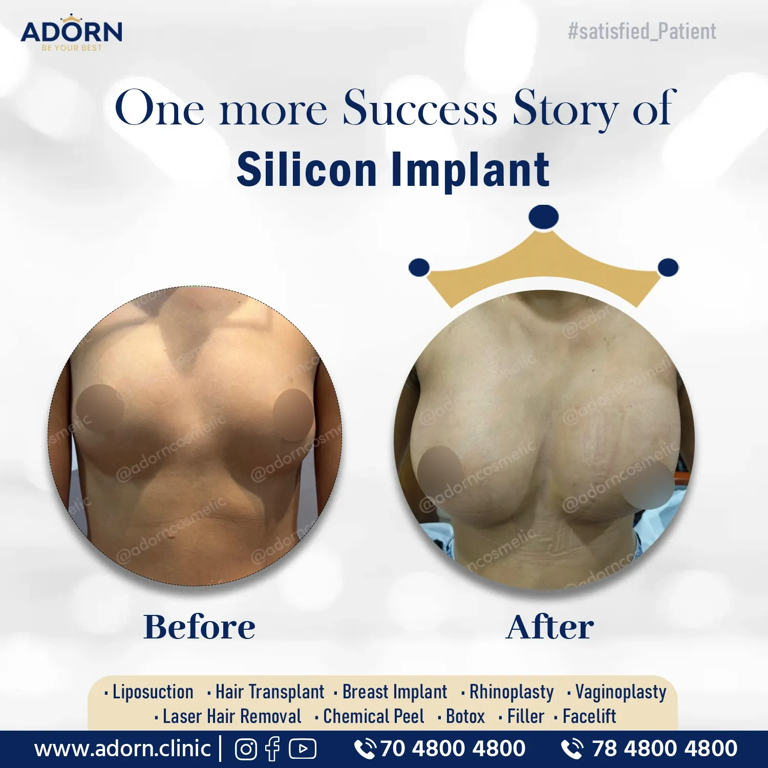 Breast Augmentation surgery before after results Ahmedabad Gujarat 