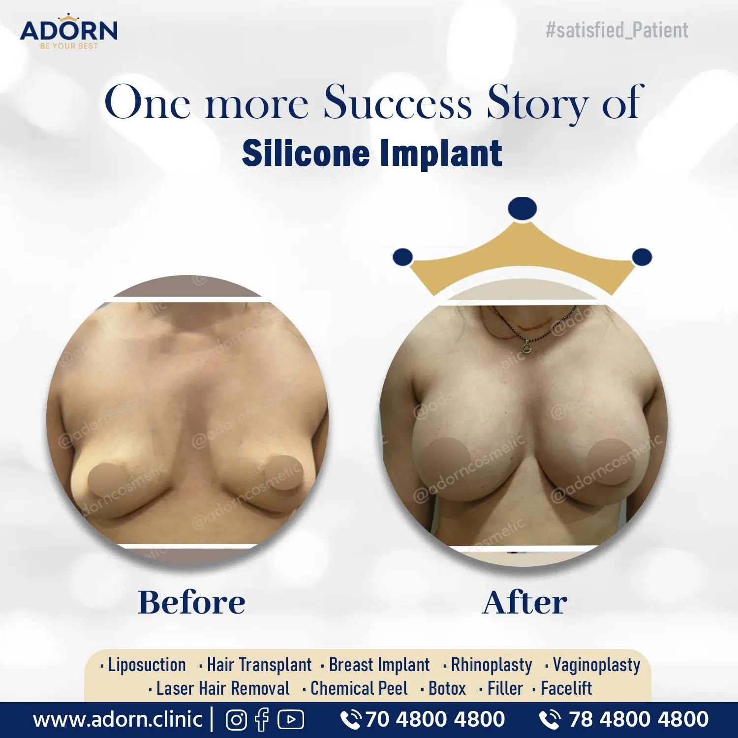 Breast Implant surgery surgery before after results Ahmedabad Gujarat 