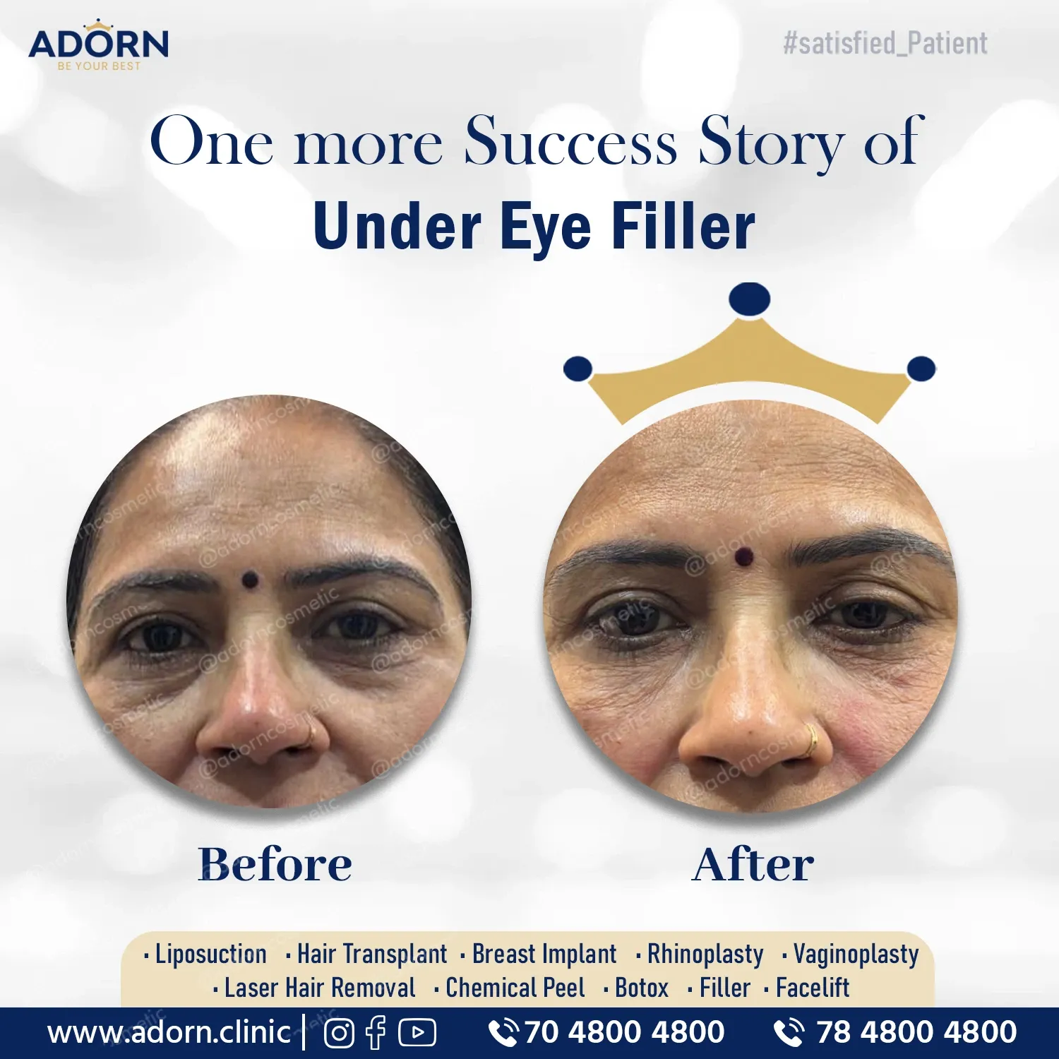 Under eye filler injection
